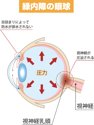 緑内障の眼球